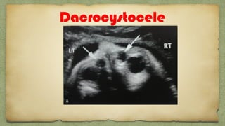 Dacrocystocele
 
