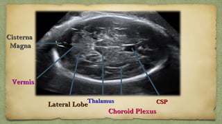 CSPCSPThalamusThalamus
Lateral LobeLateral Lobe
VermisVermis
CisternaCisterna
MagnaMagna
Choroid PlexusChoroid Plexus
 