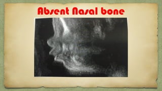 Absent Nasal bone
 