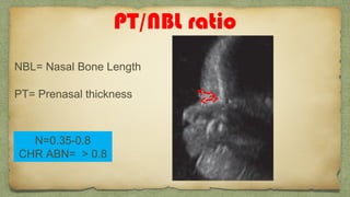 PT/NBL ratio
NBL= Nasal Bone Length
PT= Prenasal thickness
N=0.35-0.8
CHR ABN= > 0.8
 