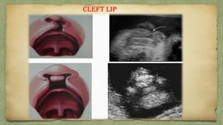 Cleft lip
 