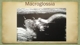 Macroglossia
 