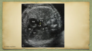 v
On Slight angulation
 