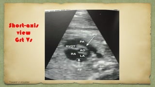 Short-axis
view
Grt Vs
Toward Lt shoulder
 