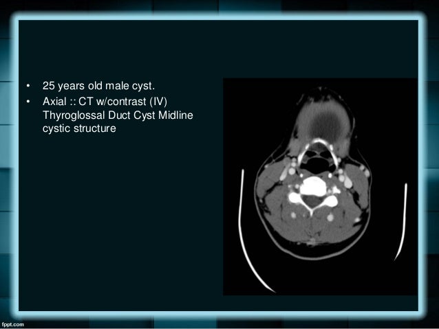 case of the week thyroglossal cyst 37 638