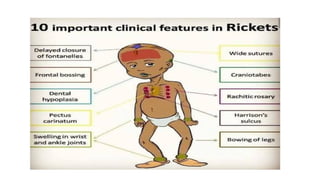 Rickets Overview Comprehensive Overview of General Orthopedic Disorders: Rickets ...
