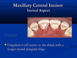 Maxillary Central IncisorMaxillary Central Incisor
Incisal AspectIncisal Aspect
CingulumCingulum
 Cingulum is off-center to the distal, with aCingulum is off-center to the distal, with a
longer mesial marginal ridgelonger mesial marginal ridge
 
