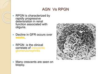 Crescentic Rpgn 2 GLOMERULAR DISEASES.pptx