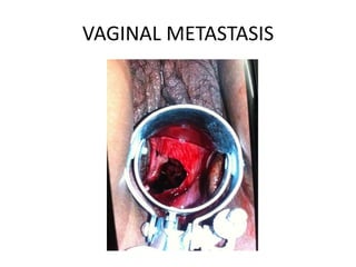 VAGINAL METASTASIS
 