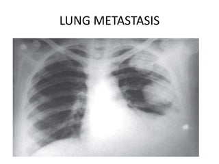 LUNG METASTASIS
 