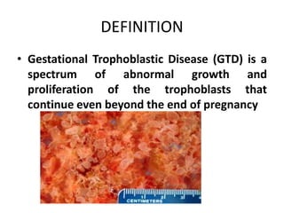 DEFINITION
• Gestational Trophoblastic Disease (GTD) is a
spectrum of abnormal growth and
proliferation of the trophoblasts that
continue even beyond the end of pregnancy
 