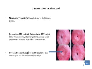 2-SEMPTOM TERİMLERİ
• Nocturia(Noktüri): Geceleri sık ve bol idrara
çıkma.
• Retantion Of Urine( Retansiyon Of Ürin):
İdrar retansiyonu, Herhangi bir nedenle idrar
yapamama sonucu aşırı idrar toplanması.
• Ureteral Strichture(Üretral Striktur): Taş,
tümör gibi bir nedenle üreter darlığı.
23
 