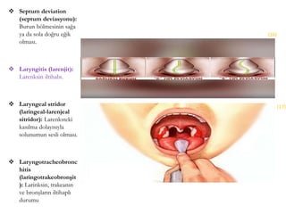  Septum deviation
(septum deviasyonu):
Burun bölmesinin sağa
ya da sola doğru eğik
olması.
 Laryngitis (larenjit):
Larenksin iltihabı.
 Laryngeal stridor
(laringeal-larenjeal
sitridor): Larenksteki
kasılma dolayısıyla
solunumun sesli olması.
 Laryngotracheobronc
hitis
(laringotrakeobronşit
): Larinksin, trakeanın
ve bronşların iltihaplı
durumu
(16)
(17)
 