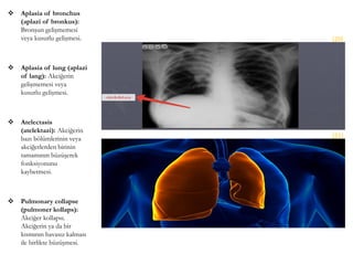  Aplasia of bronchus
(aplazi of bronkus):
Bronşun gelişmemesi
veya kusurlu gelişmesi.
 Aplasia of lung (aplazi
of lang): Akciğerin
gelişmemesi veya
kusurlu gelişmesi.
 Atelectasis
(atelektazi): Akciğerin
bazı bölümlerinin veya
akciğerlerden birinin
tamamının büzüşerek
fonksiyonunu
kaybetmesi.
 Pulmonary collapse
(pulmoner kollaps):
Akciğer kollapsı.
Akciğerin ya da bir
kısmının havasız kalması
ile birlikte büzüşmesi.
(20)
(21)
 