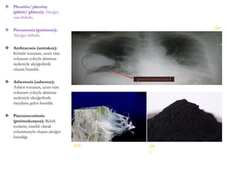  Pleuritis/ pleurisy
(plörit/ plörezi): Akciğer
zarı iltihabı.
 Pneumonia (pnömoni):
Akciğer iltihabı.
 Anthracosis (antrakoz):
Kömür tozunun, uzun süre
solunum yoluyla alınması
nedeniyle akciğerlerde
oluşan hastalık.
 Asbestosis (asbestoz):
Asbest tozunun, uzun süre
solunum yoluyla alınması
nedeniyle akciğerlerde
meydana gelen hastalık.
 Pneumoconiosis
(pnömokonyoz): Belirli
tozların, sürekli olarak
solunmasıyla oluşan akciğer
hastalığı.
(22)
(23) (24
)
 