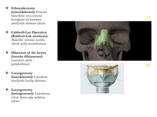  Ethmoidectomy
(etmoidektomi): Etmoid
hücerlerin veya etmoid
kemiğinin bir kısmının
ameliyetla alınması işlemi.
 Caldwell-Luc Operation
(Kaldwel-Luk ameliyatı):
Maksiller sinüsün cerrahi
olarak açılıp temizlenmesi.
 Dilatation of the larynx
(larenks dilatasyonu):
Larenksin aletle
genişletilmesi.
 Laryngectomy
(larenjektomi): Larenksin
ameliyatla kesilip alınması.
 Laryngostomy
(larengostomi): Larenksten
vücut dışına ağız açılması
işlemi.
(37)
(38)
 