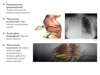  Pneumonectomy
(pnömonektomi):
Akciğer dokusunun bir
parçasını çıkarma ameliyatı.
 Thoracotomy
(torakotomi): Göğüs
kafesinin cerrahi girişimle
açılması.
 Tracheoplasty
(trakeaplasti): Trakeanın
plastik ameliyatı.
 Thoracentesis
(torasentez): Bir enjektör
yardımı ile göğüs
duvarından plevra
boşluğuna girilerek bu
alanda biriken sıvının
alınması işlemidir.
(41) (42)
(43)
 