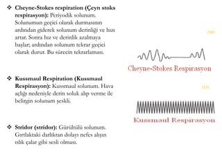  Cheyne-Stokes respiration (Çeyn stoks
respirasyon): Periyodik solunum.
Solunumun geçici olarak durmasının
ardından giderek solunum derinliği ve hızı
artar. Sonra hız ve derinlik azalmaya
başlar; ardından solunum tekrar geçici
olarak durur. Bu sürecin tekrarlaması.
 Kussmaul Respiration (Kussmaul
Respirasyon): Kussmaul solunum. Hava
açlığı nedeniyle derin soluk alıp verme ile
belirgin solunum şeskli.
 Stridor (stridor): Gürültülü solunum.
Gırtlaktaki darlıktan dolayı nefes alışın
ıslık çalar gibi sesli olması.
(56)
(57)
 