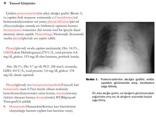  Tanısal Girişimler
Çekilen posteroanterior(ön-arka) akciğer grafisi (Resim 1)
ve yapılan fizik muayene sonrasında sol hemithorax/sol
hemitoraksda(toraksın sol yarısı) pleural effusion/plevral
efüzyon(akciğer zarında sıvı birikmesi) saptanan hastaya
thoracentesis/torasentez (bir sıvının özel bir iğneyle dışarı
alınması) işlemi yapıldı. Hemorrhage/Hemorajik (Kanamalı)
vasıfta pleural(plevral) sıvı aspire edildi.
Pleural(plevral) sıvıda yapılan incelemede; Htc: 14.5% ,
LDH(Laktat Dehidrogenaz):278 U/L, total protein: 6.8
mg/dl, glukoz: 119 mg/dl olan hastanın, periferik kanda;
Htc: 28.1%, Hb: 9.7 gr/dl, PLT: 358 mm3, serumda;
LDH: 410 U/L, total protein: 5.6 mg/dl, glukoz: 154
mg/dl, olarak saptandı.
Pleural(plevral) sıvı hematocriti/periferik(Yüzeyel) kan
hematocriti oranı 0.5’ten büyük olması nedeniyle
hemothorax(hemotoraks) tanısı konan, trauma(travma)
öyküsü olmayan hastaya thorax(toraks) BT(Bilgisayarlı
Tomografi)’si çekildi.
 Hematocrit/Hematokrit(Kırmızı kan hücrelerinin
oluşturduğu hacmin toplam kan hacmine oranı)
(62)
Ön-arka akciğer grafisi; sol akciğerin görüntüsündeki
yoğunlukta artış var, iki akciğerin arasındaki boşluk
sağa itilmiş.
 