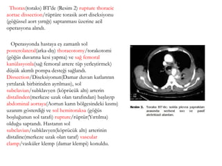 Thorax(toraks) BT’de (Resim 2) rupture thoracic
aortae dissection/rüptüre torasik aort diseksiyonu
(göğüssel aort yırtığı) saptanması üzerine acil
operasyona alındı.
Operasyonda hastaya eş zamanlı sol
posterolateral(arka-dış) thoracotomy/torakotomi
(göğüs duvarına kesi yapma) ve sağ femoral
kanülasyonla(sağ femoral artere tüp yerleştirmek)
düşük akımlı pompa desteği sağlandı.
Dissection/Diseksiyonun(Damar duvarı katlarının
yırtılarak birbirinden ayrılması), sol
subclavian/subklavyen (köprücük altı) arterin
distalinden(merkeze uzak olan tarafından) başlayıp
abdominal aortaya(Aortun karın bölgesindeki kısmı)
uzanım gösterdiği ve sol hemitoraksa (göğüs
boşluğunun sol tarafı) rupture/rüptür(Yırtılma)
olduğu saptandı. Hastanın sol
subclavian/subklavyen(köprücük altı) arterinin
distaline(merkeze uzak olan taraf) vascular
clamp/vasküler klemp (damar klempi) konuldu.
 