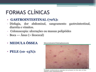 FORMAS CLÍNICAS
• GASTROINTESTINAL (70%):
- Disfagia, dor abdominal, sangramento gastrointestinal,
diarréia e vômitos.
- Colonoscopia: ulcerações ou massas polipóides
- Boca --- Ânus (> ileocecal)

• MEDULA ÓSSEA
• PELE (10 -15%):

 