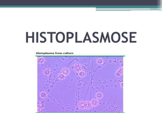 HISTOPLASMOSE

 
