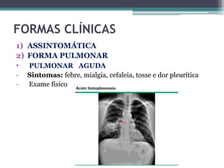 FORMAS CLÍNICAS
1) ASSINTOMÁTICA
2) FORMA PULMONAR
• PULMONAR AGUDA
-

Sintomas: febre, mialgia, cefaleia, tosse e dor pleurítica
Exame físico

 