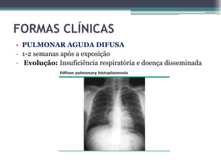 FORMAS CLÍNICAS
• PULMONAR AGUDA DIFUSA
- 1-2 semanas após a exposição
- Evolução: Insuficiência respiratória e doença disseminada

 