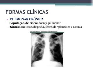 FORMAS CLÍNICAS
• PULMONAR CRÔNICA
- População de risco: doença pulmonar
- Sintomas: tosse, dispnéia, febre, dor pleurítica e astenia

 