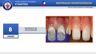 UNIDAD
8 MATERIALES DE
RESTAURACIÓN
MATERIALES ODONTOLÓGICOS
Carrera: Técnico Superior en odontología
 