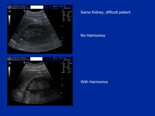 Same Kidney, difficult patient No Harmonics With Harmonics 