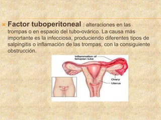  Factor tuboperitoneal : alteraciones en las
trompas o en espacio del tubo-ovárico. La causa más
importante es la infecciosa, produciendo diferentes tipos de
salpingitis o inflamación de las trompas, con la consiguiente
obstrucción.
 