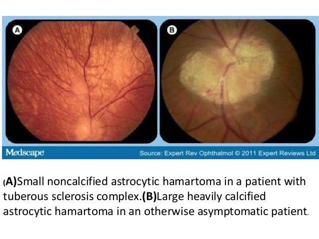 intraocular tumours