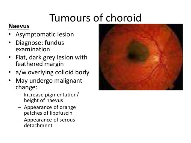 intraocular tumours uveal tract