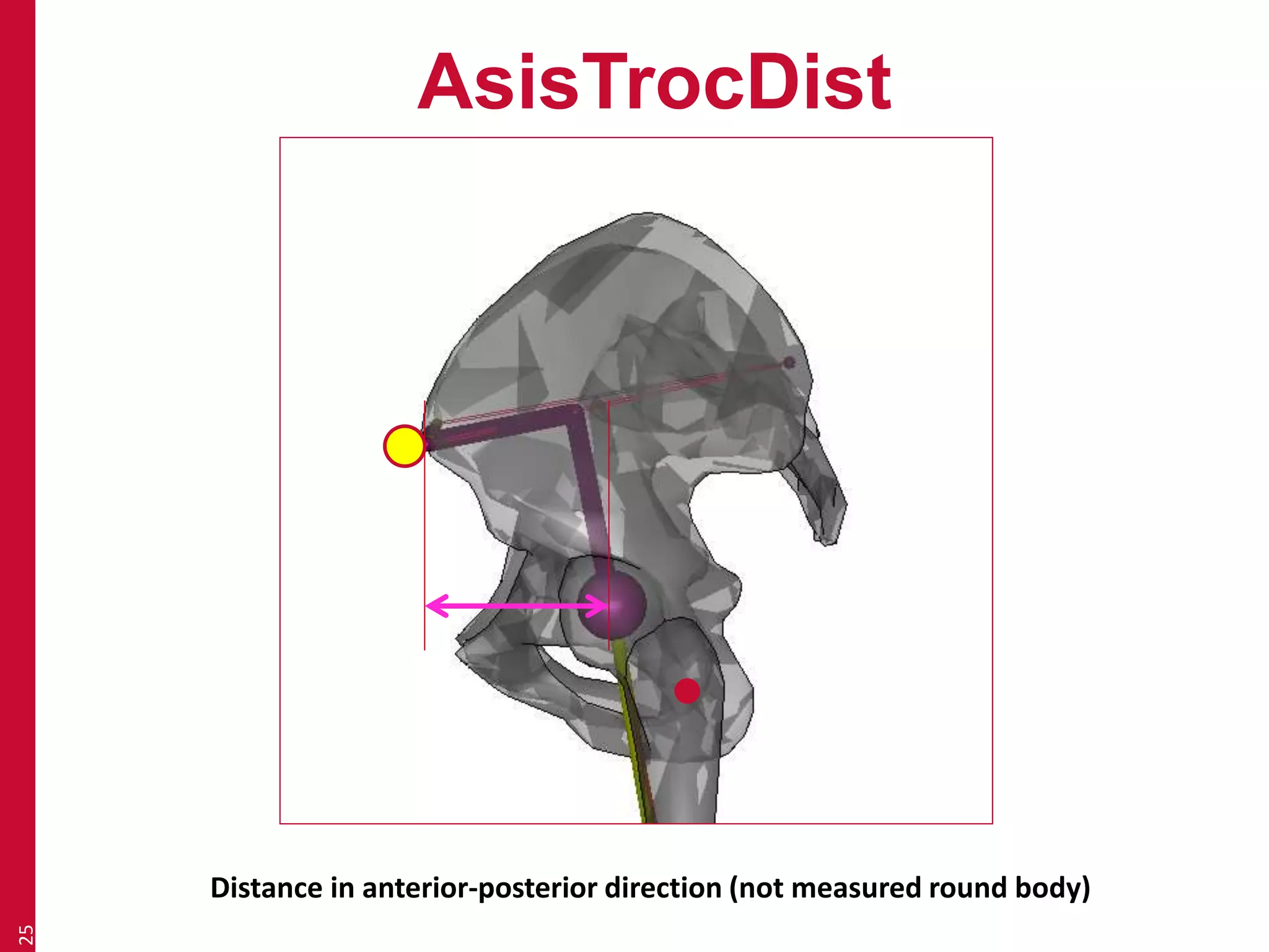 AsisTrocDist 
25 
Distance in anterior-posterior direction (not measured round body) 
 