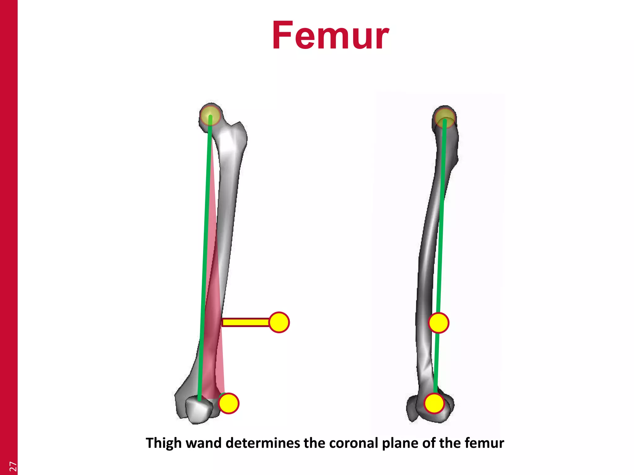 Femur 
27 
Thigh wand determines the coronal plane of the femur 
 