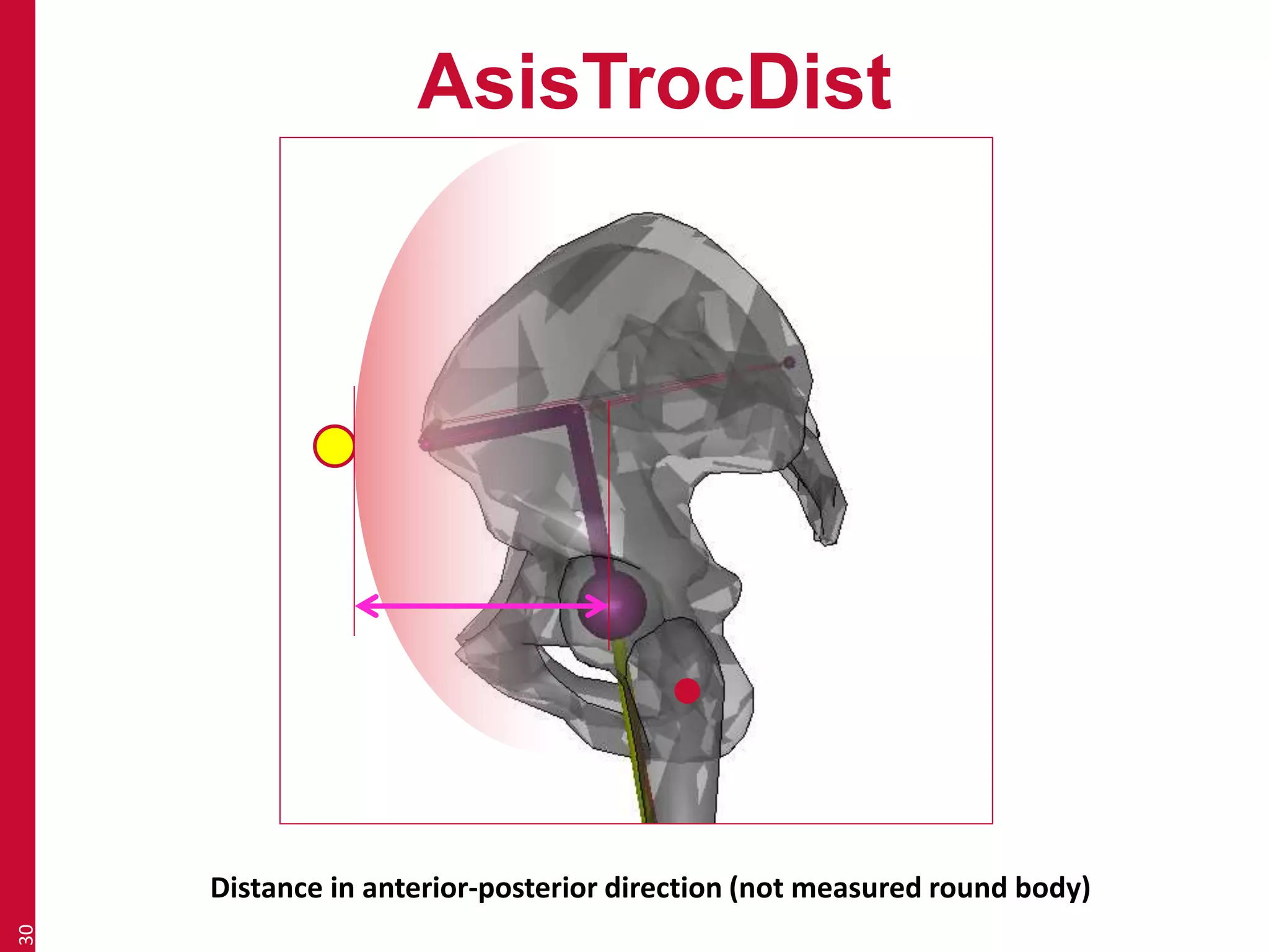 AsisTrocDist 
30 
Distance in anterior-posterior direction (not measured round body) 
 