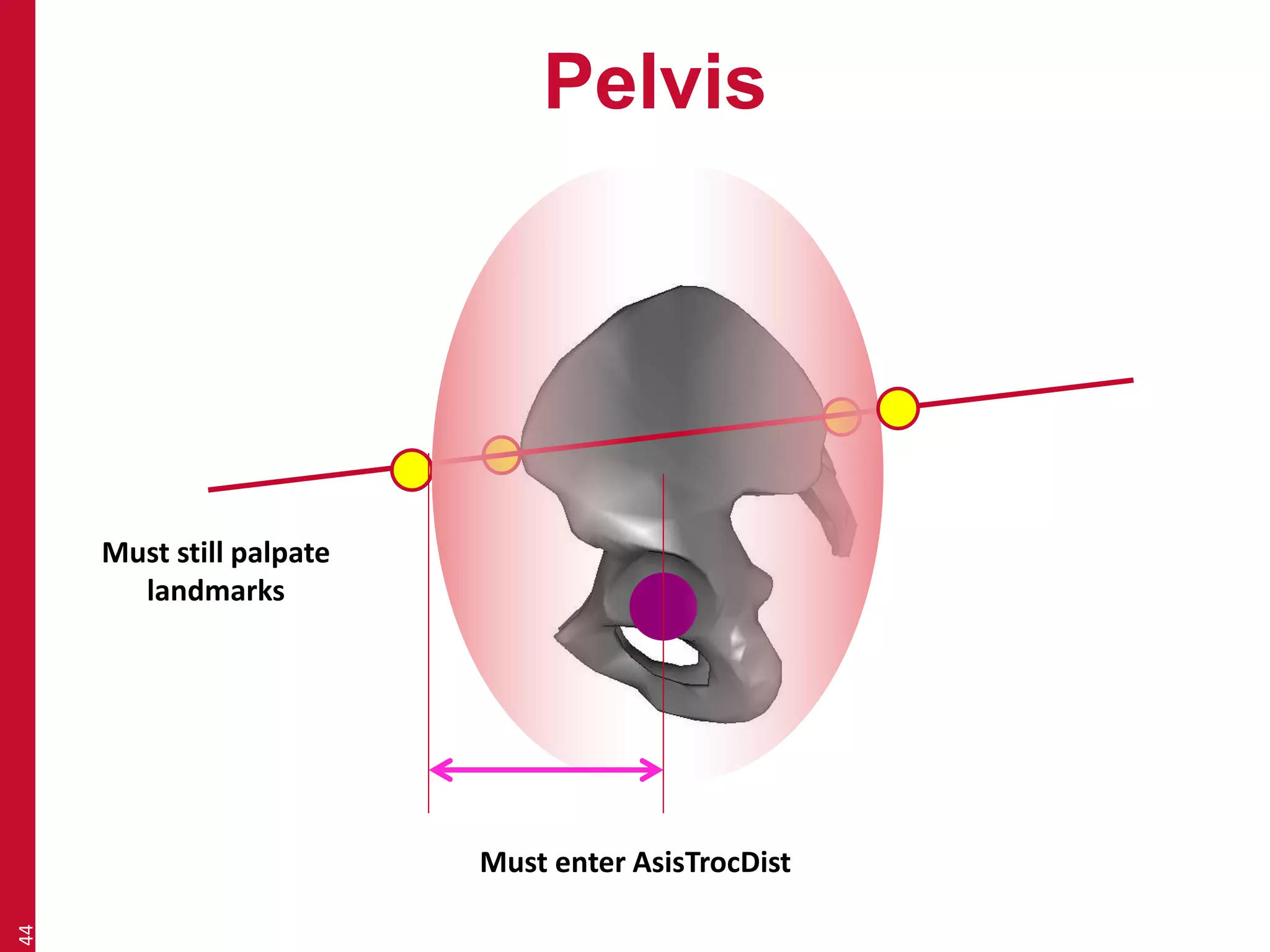 Pelvis 
44 
Must enter AsisTrocDist 
Must still palpate 
landmarks 
 