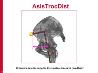AsisTrocDist 
29 
Distance in anterior-posterior direction (not measured round body) 
 
