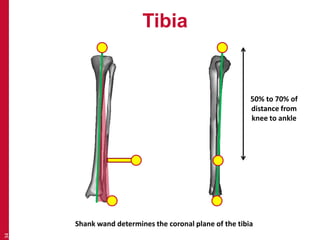 Tibia 
34 
50% to 70% of 
distance from 
knee to ankle 
Shank wand determines the coronal plane of the tibia 
 
