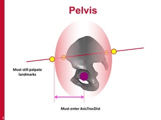 Pelvis 
44 
Must enter AsisTrocDist 
Must still palpate 
landmarks 
 