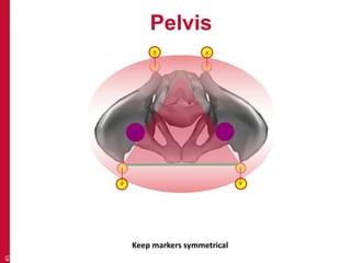 Pelvis 
45 
Keep markers symmetrical 
 