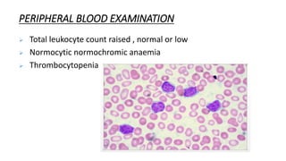 PERIPHERAL BLOOD EXAMINATION
 Total leukocyte count raised , normal or low
 Normocytic normochromic anaemia
 Thrombocytopenia
 