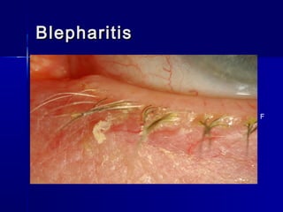BlepharitisBlepharitis
F
 