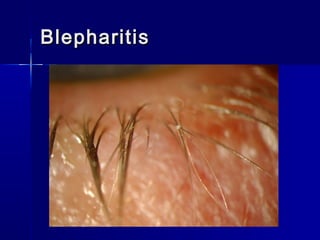 BlepharitisBlepharitis
 