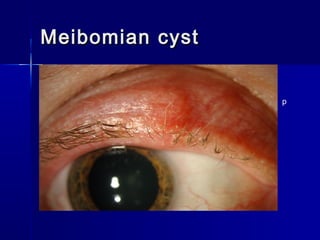Meibomian cystMeibomian cyst
p
 