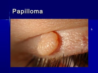 PapillomaPapilloma
b
 