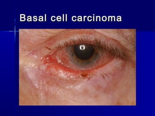 Basal cell carcinomaBasal cell carcinoma
 
