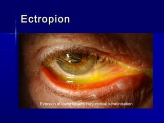 EctropionEctropion
Eversion of lower lid with conjunctival keratinisation
 