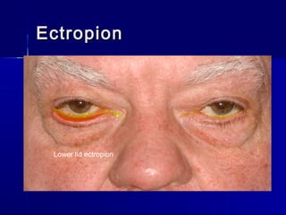 EctropionEctropion
Lower lid ectropion
 